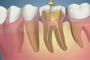 Complication-Constricted or Calciffed Canal